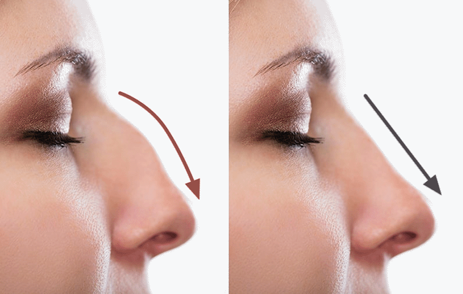 Rhinoplasty (Nose Shaping)