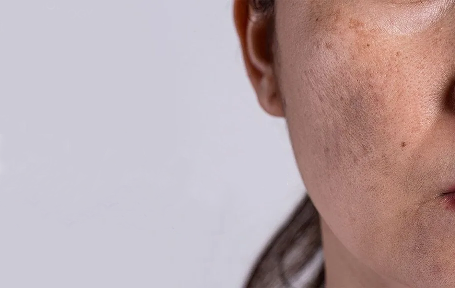Melasma Treatment